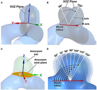 The Impact of Inflow Angle on Aneurysm Hemodynamics: A Simulation Study Based on Patient-Specific Intracranial Aneurysm Models